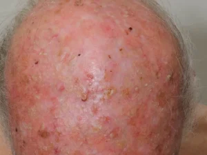 υπερκερατωσεις