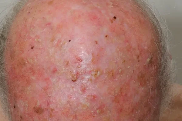 ΑΚΤΙΝΙΚΕΣ ΥΠΕΡΚΕΡΑΤΩΣΕΙΣ: ΕΝΑΣ ΥΠΟΥΛΟΣ ΕΧΘΡΟΣ