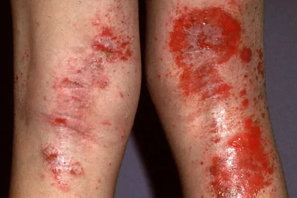 ΑΤΟΠΙΚΗ ΔΕΡΜΑΤΙΤΙΔΑ