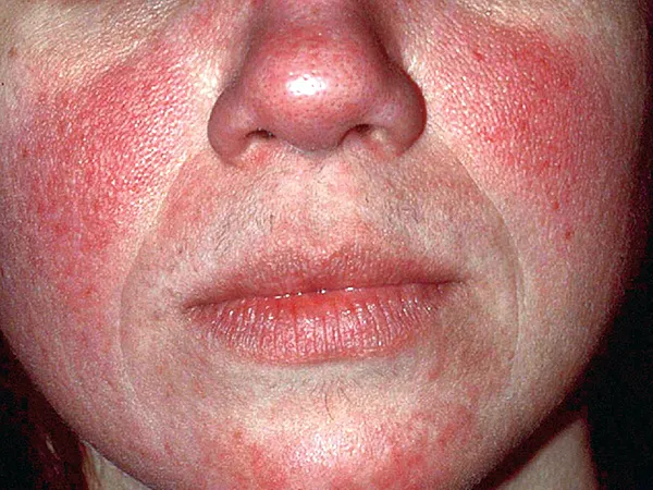 ερυθροτητα 1