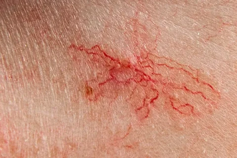 ΘΕΡΑΠΕΙΑ ΕΡΥΘΡΟΤΗΤΑΣ ΚΑΙ ΕΥΡΥΑΓΓΕΙΩΝ