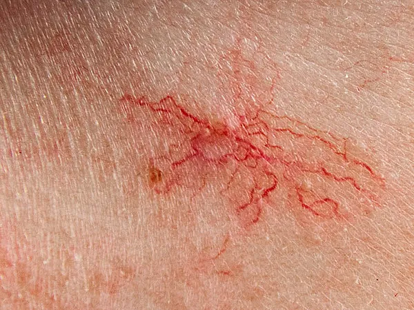 ερυθρότητα 2