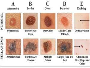 κακοηθης μελάνωμα