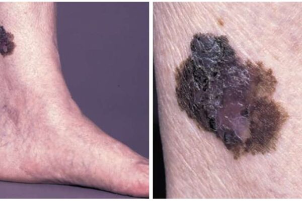 ΚΑΚΟΗΘΕΣ ΜΕΛΑΝΩΜΑ