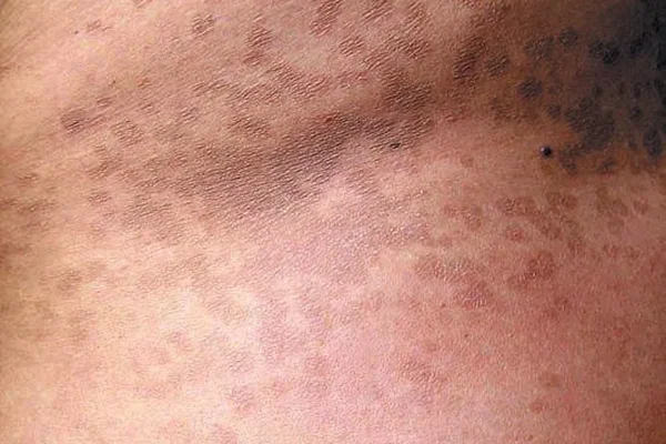 ΠΟΙΚΙΛΟΧΡΟΥΣ ΠΙΤΥΡΙΑΣΗ: ΕΝΑΣ ΣΥΧΝΟΣ ΦΘΙΝΟΠΩΡΙΝΟΣ ΕΠΙΣΚΕΠΤΗΣ