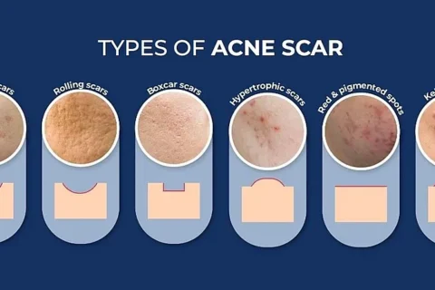 ΘΕΡΑΠΕΙΑ ΟΥΛΩΝ ΑΚΜΗΣ