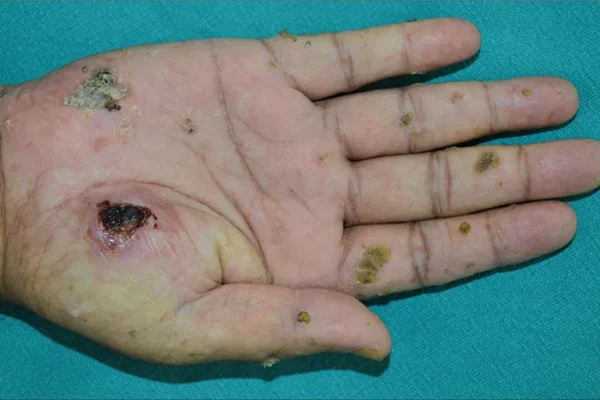 ΧΗΜΙΚΕΣ ΟΥΣΙΕΣ ΚΑΙ ΚΑΡΚΙΝΟΣ ΤΟΥ ΔΕΡΜΑΤΟΣ