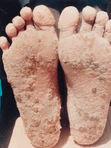 υπερκερατωση